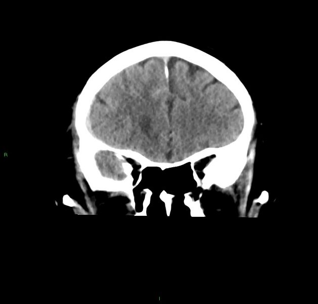 File:Cerebral amyloid angiopathy-associated lobar intracerebral hemorrhage (Radiopaedia 59356-66716 Coronal non-contrast 47).jpg