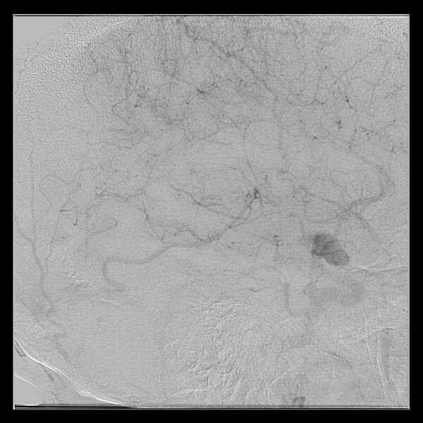 File:Cerebral aneurysm with rupture (Radiopaedia 29933-30458 LT ICA IC 46).jpg