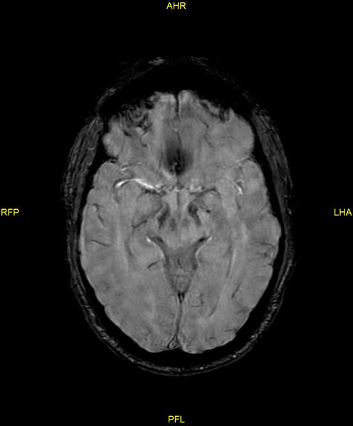 File:Cerebral autosomal dominant arteriopathy with subcortical infarcts and leukoencephalopathy (CADASIL) (Radiopaedia 86108-102054 Axial SWI 49).jpg