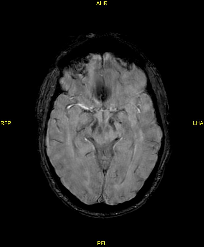 Cerebral autosomal dominant arteriopathy with subcortical infarcts and leukoencephalopathy (CADASIL) (Radiopaedia 86108-102054 Axial SWI 49).jpg