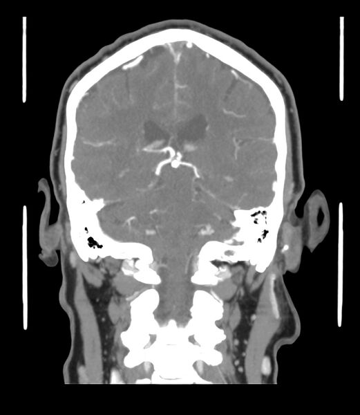 File:Cerebral dural venous sinus thrombosis (Radiopaedia 86514-102576 B 45).jpg