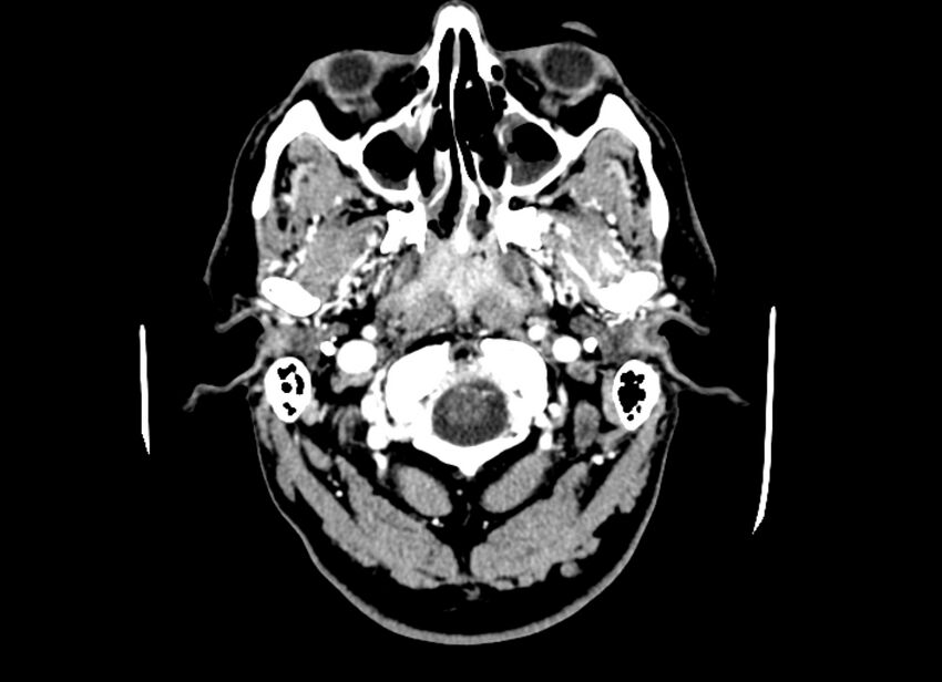 Cerebral edema (Radiopaedia 82519-96661 B 54).jpg