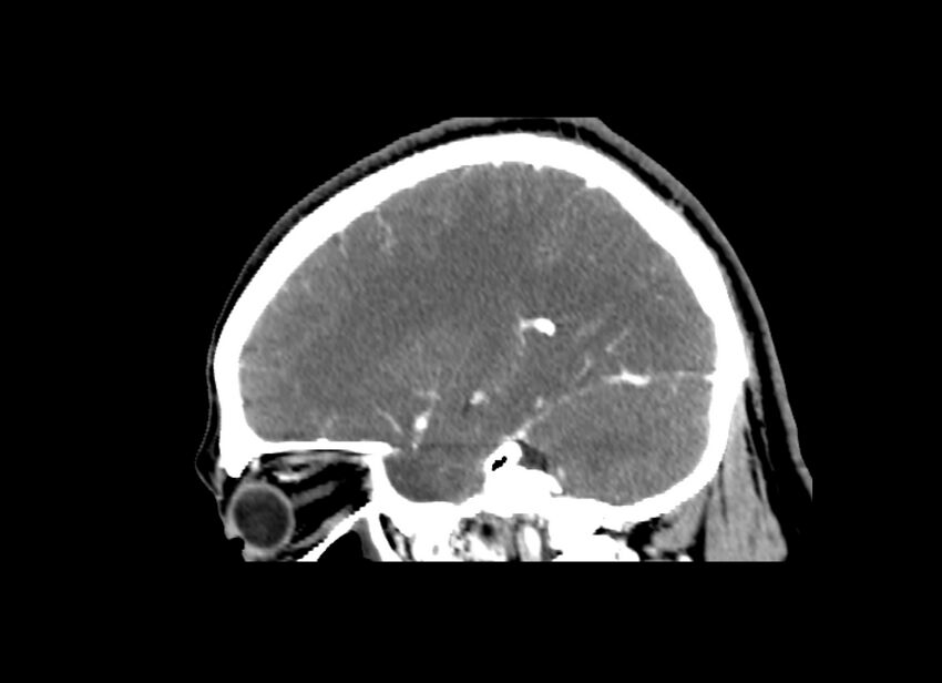 Cerebral edema (Radiopaedia 82519-96661 D 36).jpg