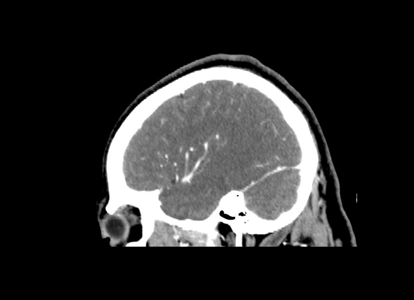 Cerebral edema (Radiopaedia 82519-96661 D 41).jpg