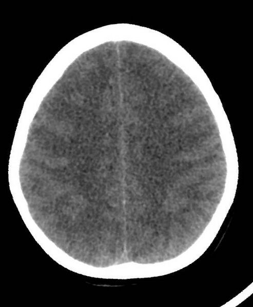 File:Cerebral edema due to severe hyponatremia (Radiopaedia 89826-106937 Axial non-contrast 65).jpg