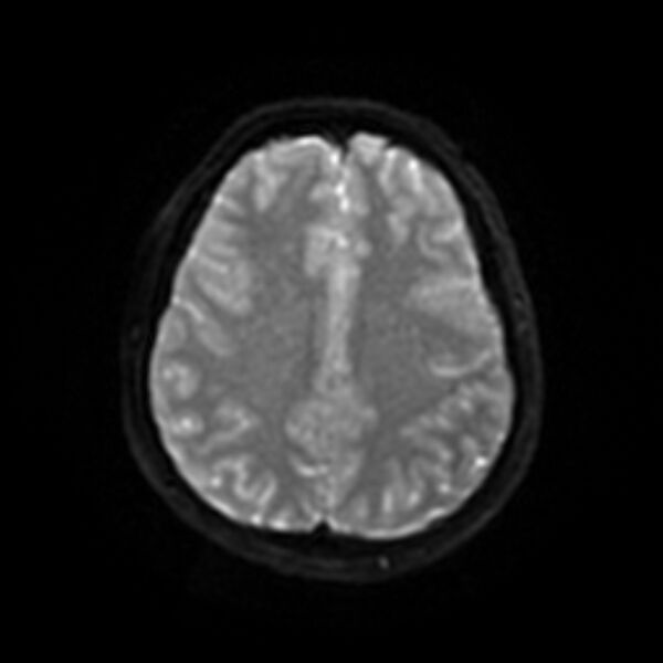 File:Cerebral fat embolism (Radiopaedia 37510-39363 Axial DWI 42).jpg