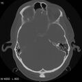 Cerebral hemorrhagic contusion with subdural and subarachnoid hemorrhage (Radiopaedia 10680-11146 Axial bone window 12).jpg