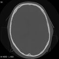 Cerebral hemorrhagic contusion with subdural and subarachnoid hemorrhage (Radiopaedia 10680-11146 Axial bone window 17).jpg