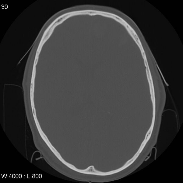 File:Cerebral hemorrhagic contusion with subdural and subarachnoid hemorrhage (Radiopaedia 10680-11146 Axial bone window 17).jpg