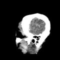 Cerebral hemorrhagic contusions (Radiopaedia 23145-23188 C 39).jpg