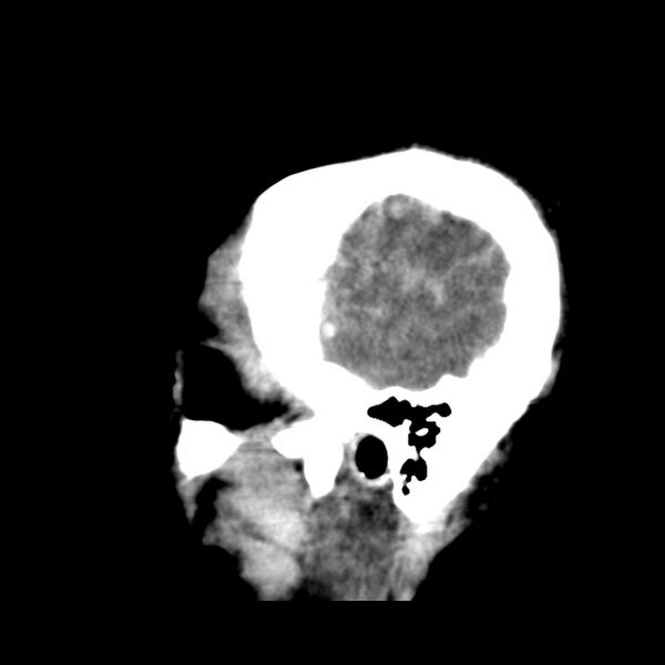 File:Cerebral hemorrhagic contusions (Radiopaedia 23145-23188 C 39).jpg