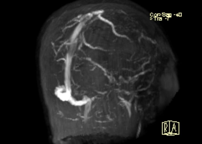 File:Cerebral venous infarct (Radiopaedia 53627-59723 3D MRV 13).jpg