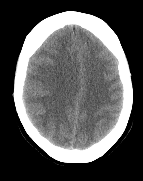 File:Cerebral venous infarct related to dural venous sinus thromboses (Radiopaedia 35292-36803 AXIAL THICK 19).png