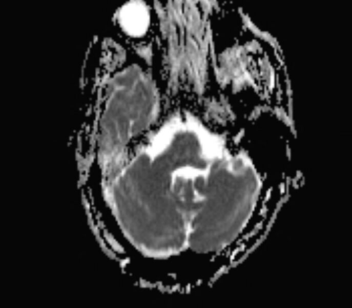 File:Cerebral venous thrombosis (Radiopaedia 71207-81504 Axial ADC 4).jpg
