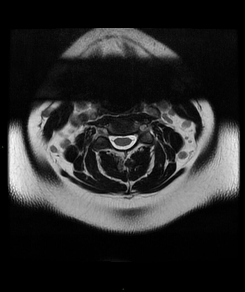 Cervical disc prolapse (Radiopaedia 80258-93598 Axial T2 11).jpg