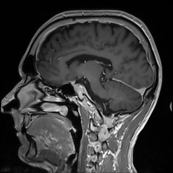 File:Cervical dural CSF leak on MRI and CT treated by blood patch (Radiopaedia 49748-54995 G 47).jpg
