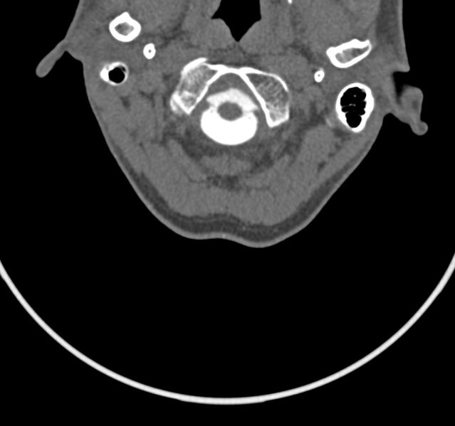 File:Cervical dural CSF leak on MRI and CT treated by blood patch (Radiopaedia 49748-54996 B 9).png