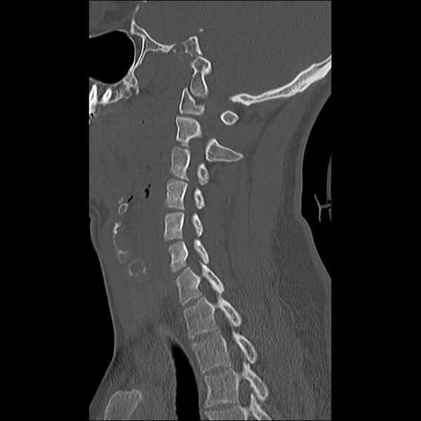 File:Cervical facet fracture and anterior discoligamentous injury (Radiopaedia 32139-33083 Sagittal bone window 13).jpg