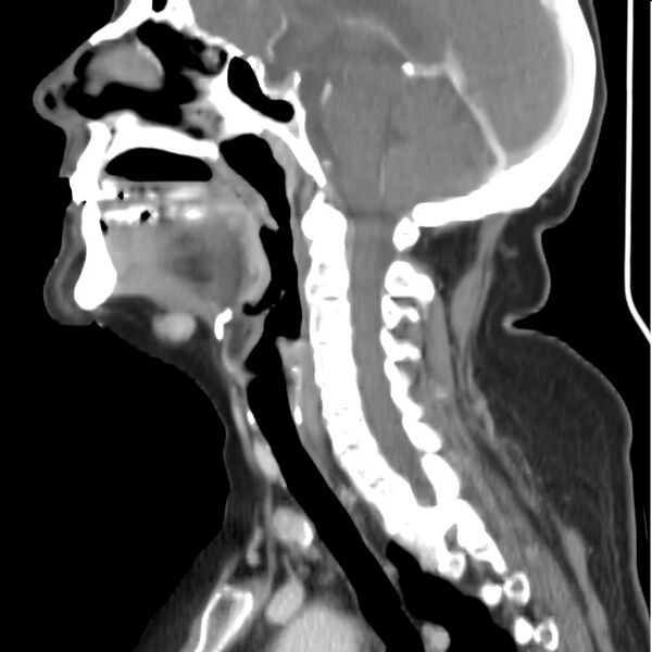 File:Cervical lymphadenopathy- cause unknown (Radiopaedia 22420-22457 D 19).jpg