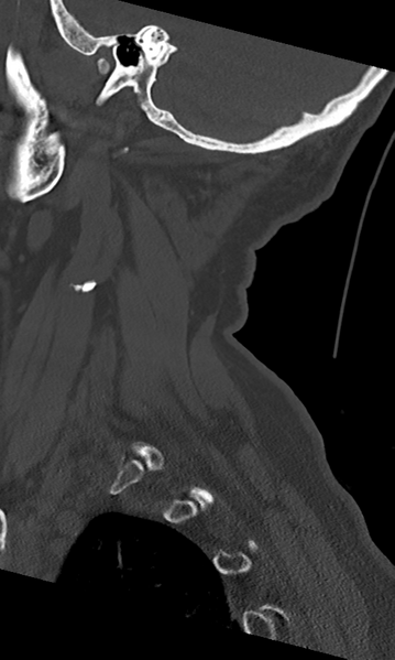 File:Cervical spine fracture - chalk stick (Radiopaedia 39116-41323 Sagittal bone window 11).png