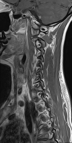 File:Cervical spondylodiscitis and calvarial hemangioma (Radiopaedia 64317-73104 Sagittal T1 C+ 3).jpg