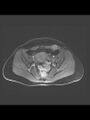 Cesarean section scar endometrioma (Radiopaedia 56569-63297 Axial T1 C+ fat sat 24).jpg