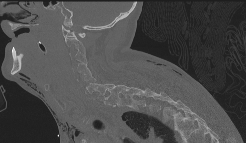 Chalk stick fracture (Radiopaedia 57948-64928 Sagittal bone window 42).png