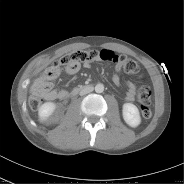 File:Chest and abdomen multi-trauma (Radiopaedia 26294-26426 A 42).jpg