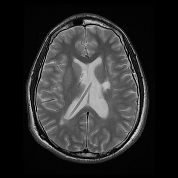 File:Chiasmatic-hypothalamic juvenile pilocytic astrocytoma (Radiopaedia 78533-91235 Axial T2 17).jpg