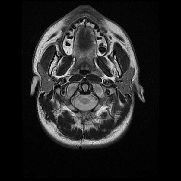 File:Chiasmatic-hypothalamic juvenile pilocytic astrocytoma (Radiopaedia 78533-91235 Axial T2 2).jpg