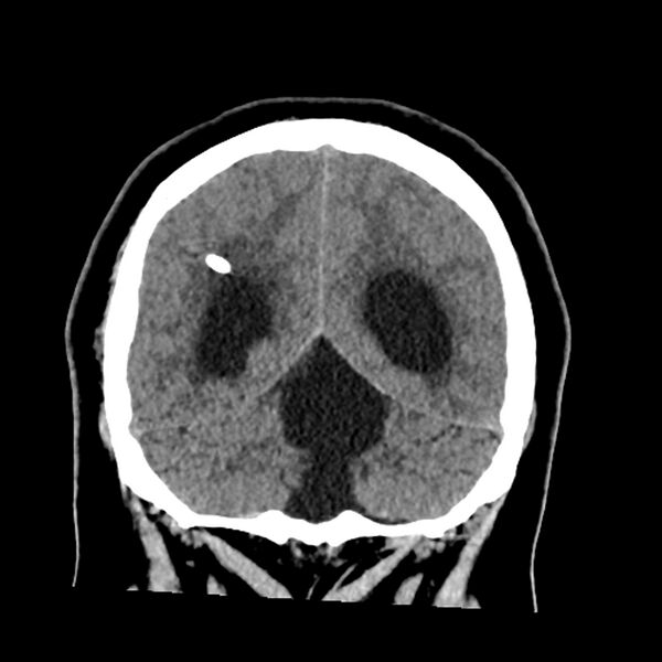 File:Chiasmatic-hypothalamic juvenile pilocytic astrocytoma (Radiopaedia 78533-91237 Coronal non-contrast 53).jpg