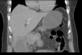 Cholecystitis - CT IVC obstructive choledocholitiasis (Radiopaedia 43966-47479 Coronal Biliscopin 20).png