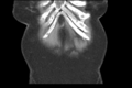 Cholecystitis - CT IVC obstructive choledocholitiasis (Radiopaedia 43966-47479 Coronal Biliscopin 7).png