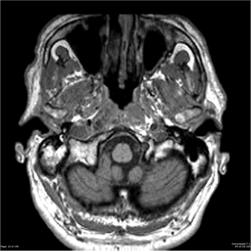 Chondrosarcoma of skull base- grade II (Radiopaedia 40948-43654 Axial T1 10).jpg