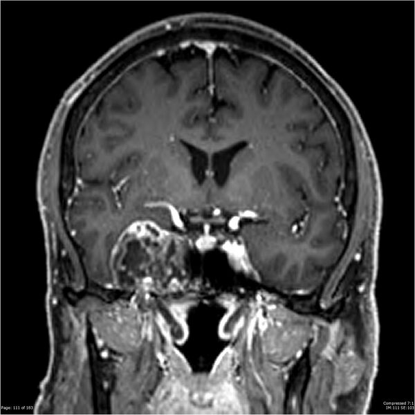 File:Chondrosarcoma of skull base- grade II (Radiopaedia 40948-43654 Coronal T1 C+ 22).jpg