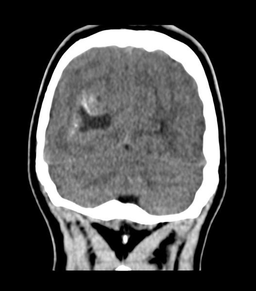 File:Choroid plexus carcinoma (Radiopaedia 91013-108552 Coronal non-contrast 71).jpg