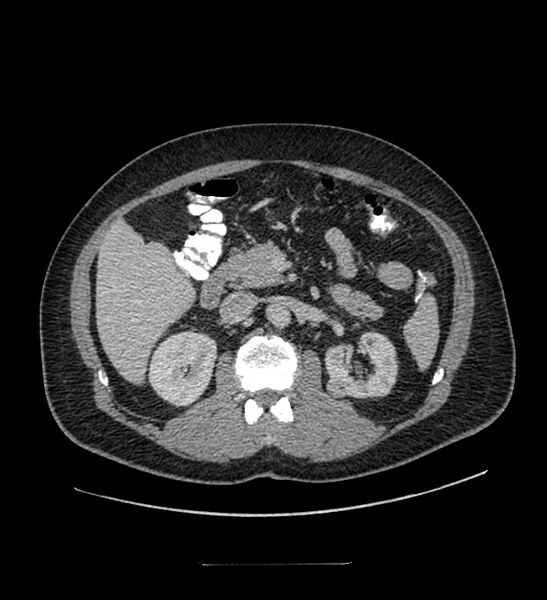 File:Chromophobe renal cell carcinoma (Radiopaedia 84337-99644 C 50).jpg