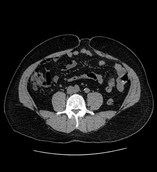 File:Chromophobe renal cell carcinoma (Radiopaedia 84337-99693 Axial non-contrast 92).jpg