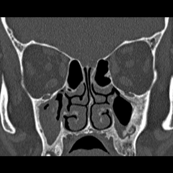 File:Chronic maxillary sinusitis (Radiopaedia 27879-28116 Coronal bone window 27).jpg