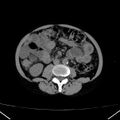 Chronic pancreatitis (Radiopaedia 23132-23172 Axial non-contrast 46).jpg