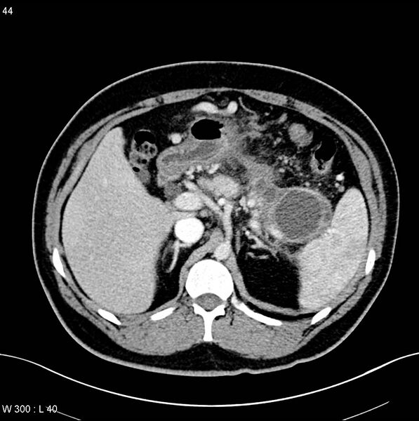 File:Chronic pancreatitis and pseudocysts (Radiopaedia 6724-7935 B 5).jpg