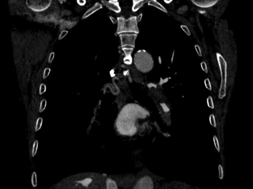 Chronic pulmonary embolism (Radiopaedia 91241-108843 A 67).jpg