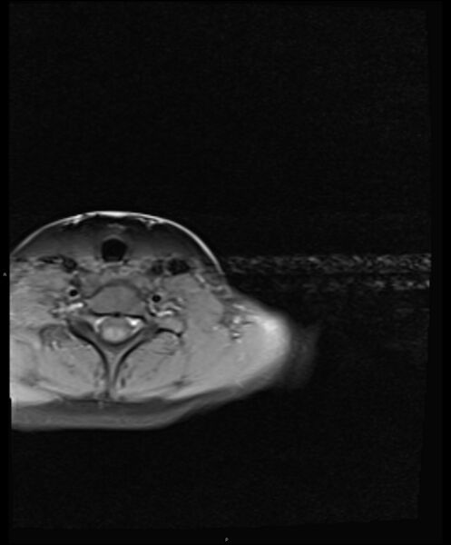 File:Chronic reactive multifocal osteomyelitis (CRMO) - clavicle (Radiopaedia 56406-63114 Axial T1 fat sat 4).jpg