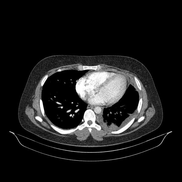 File:Chronic thromboembolic pulmonary hypertension (CTEPH) (Radiopaedia 74597-85532 Axial C+ CTPA 63).jpg