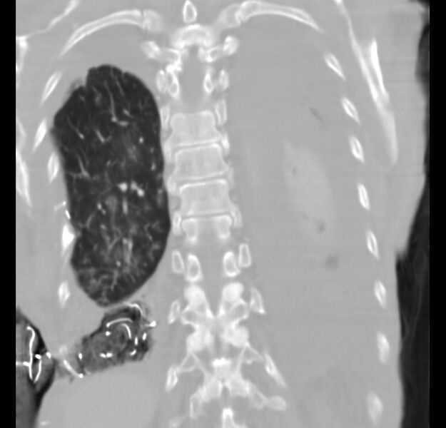 File:Clagett thoracotomy with bronchopleural fistula (Radiopaedia 29192-29587 Coronal lung window 5).jpg