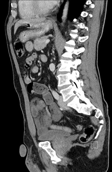File:Closed loop small bowel obstruction - internal hernia (Radiopaedia 57806-64778 C 50).jpg