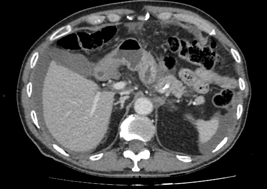 Closed loop small bowel obstruction with ischemia (Radiopaedia 84180-99456 A 27).jpg