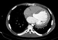 Coarctation of aorta with aortic valve stenosis (Radiopaedia 70463-80574 A 143).jpg