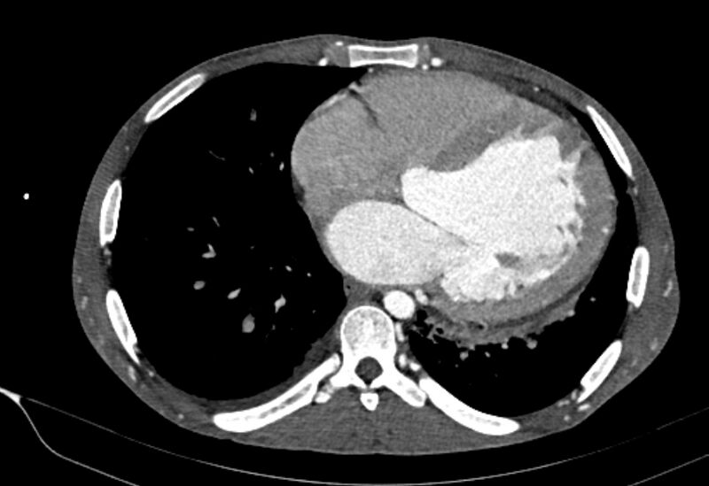 File:Coarctation of aorta with aortic valve stenosis (Radiopaedia 70463-80574 A 143).jpg