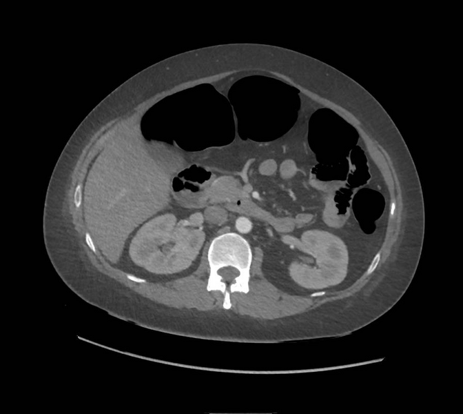File:Colonic pseudo-obstruction (Radiopaedia 79752-92980 A 72).png
